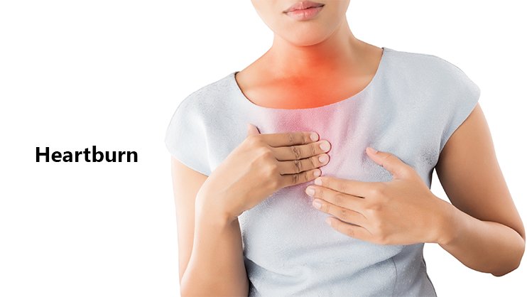Acid reflux, Heartburn, Gastic