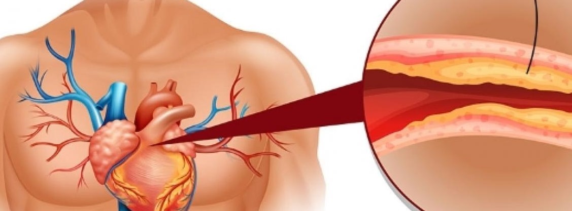 Cholesterol  Reduce Foumula